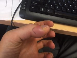The thumb was so swollen, even everyday tasks like typing or grabbing the shower handle caused pain. Pre bentonite clay.